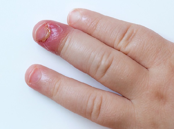 علائم عفونت مفاصل در کودکان،درمان عفونت استخوان در کودکان،درمان عفونت مفصل های کودکان