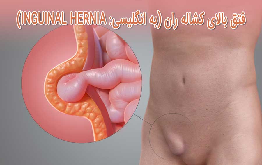 درد ران پا - علائم و روش های درمان و تسکین درد ران پا