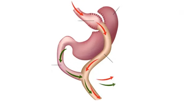 چه کسانی کاندیدای بای پس معده و اسلیو معده هستند؟