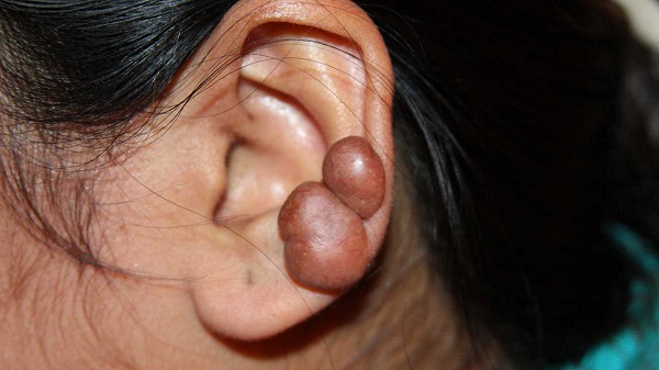  کلوئید در ناحیه گوش