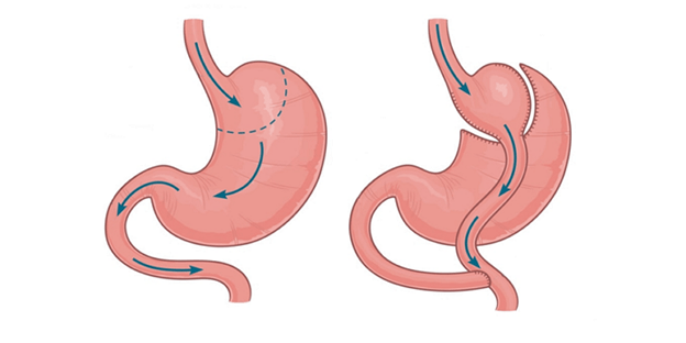 اسلیو معده یا بای پس معده؟ مقایسه تخصصی با دکتر محمد ایرانمنش