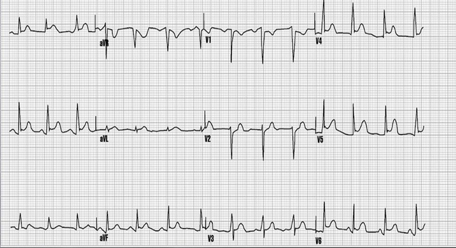 پریکاردیت (التهاب قلب) چیست ؟ علائم و روش های درمان