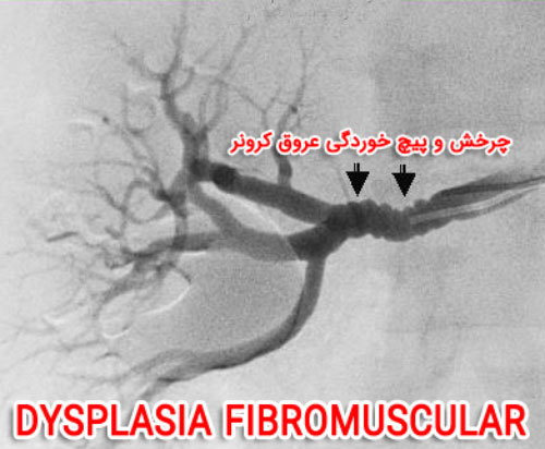 Dysplasia Fibromuscular (FMD)