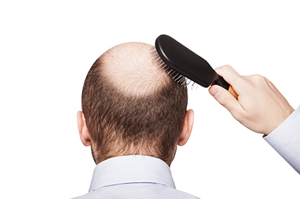 طاسی ارثی - کچل شدن ژنتیکی