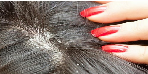 شوره سر و روش هایی برای جلوگیری از آن در زمستان