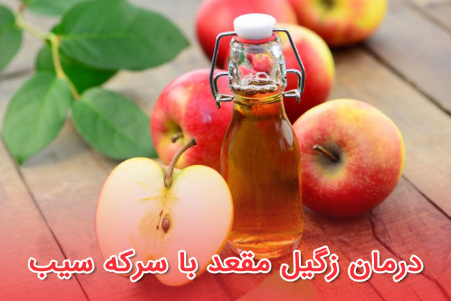 درمان زگیل مقعد با سرکه سیب 