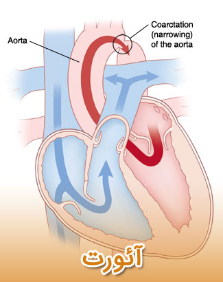 علائم درد قفسه سینه مربوط به مشکلات آئورت