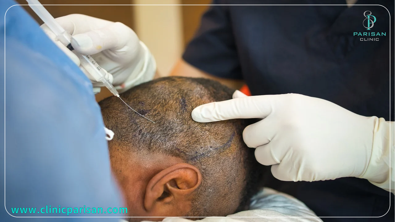 کاشت مو در تابستان