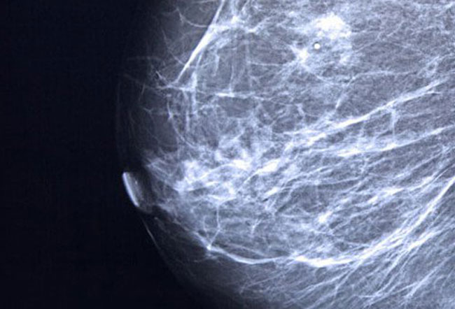 ماموگرافی نوعی روش پرتونگاری است که می تواند برای تشخیص سرطان پستان