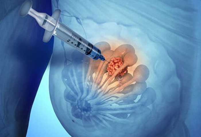 بیوپسی سینه ممکن است به وسیله سوزن و یا عمل جراحی انجام شود.