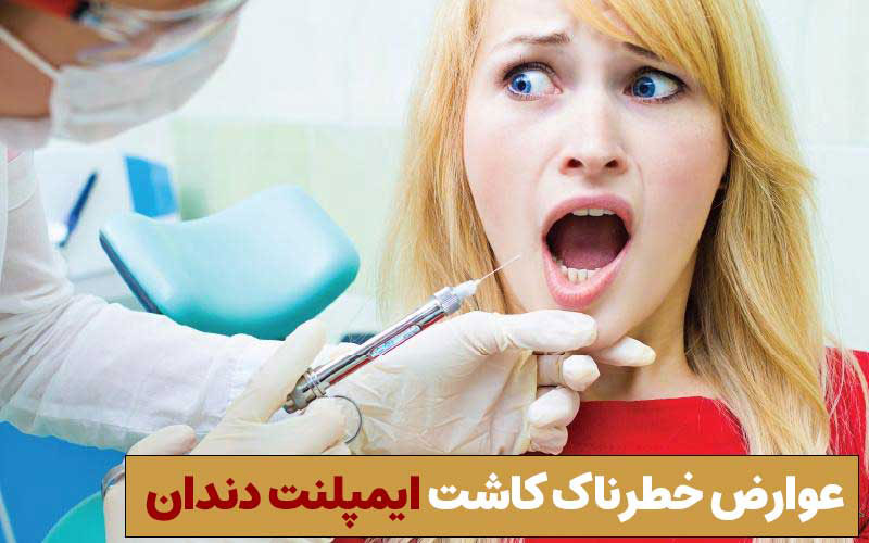 عوارض خطرناک کاشت ایمپلنت دندان