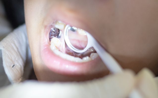 ترکیب فلزات تشکیل دهنده آمالگام