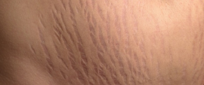 سلولیت چیست؟ روش های خانگی و گیاهی "درمان سلولیت"