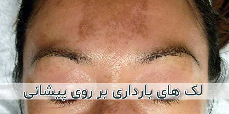 لک صورت در بارداری - دلایل + روش های درمان و پیشگیری