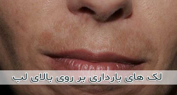 لک بارداری صورت بر روی بالای لب