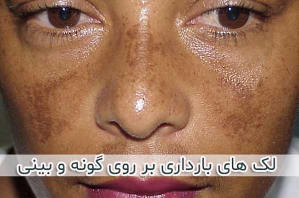 لک های بارداری بر روی گونه و بینی