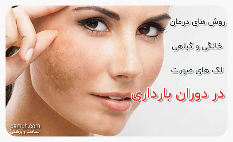 لک صورت در بارداری - دلایل + روش های درمان و پیشگیری