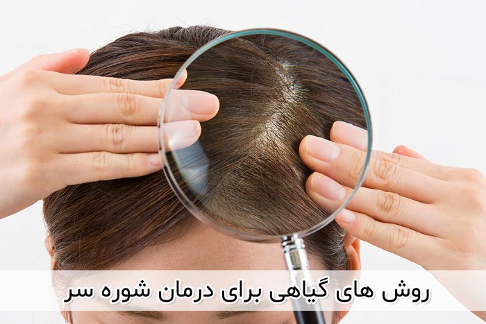 استفاده از روغن نارگیل برای درمان شوره سر 