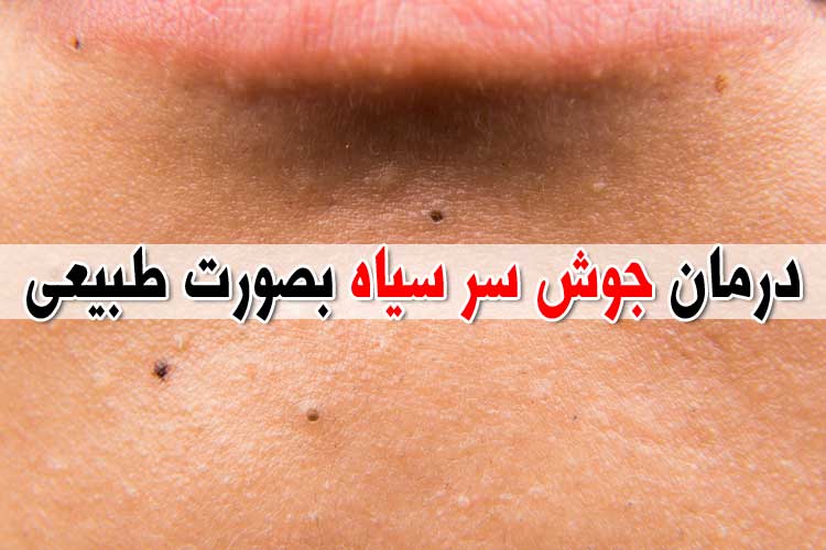 درمان جوش سر سیاه بصورت طبیعی و قطعی