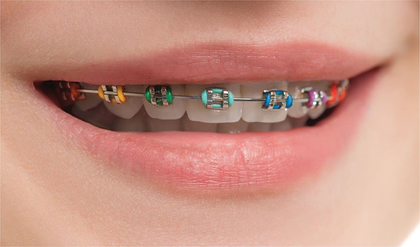 انواع سیم ارتودنسی از منظر جنس