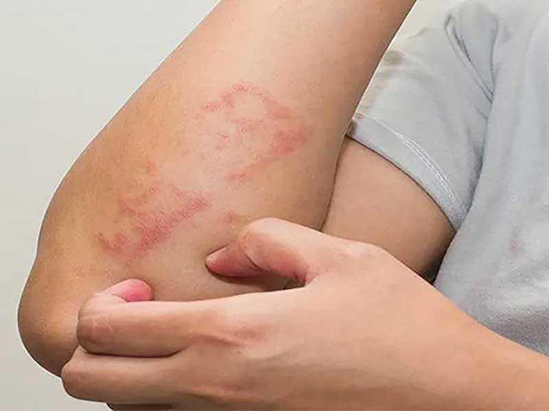 اگزمای پوستی به چه دلیل ایجاد می شود؟