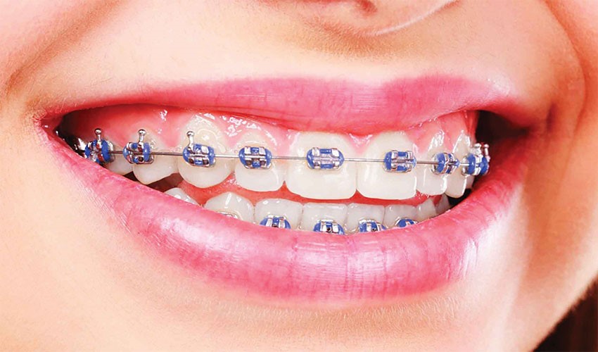 بررسی جامع انواع سیم ارتودنسی و ویژگیهای آنها