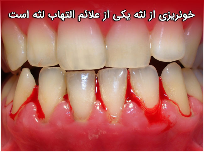 ژنژیویت - علائم - دلایل و 10 روش درمان خانگی "التهاب لثه"