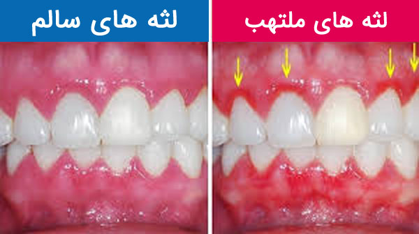 لثه های سالم معمولا صورتی رنگ هستند و ممکن است حاوی ملانین باشند