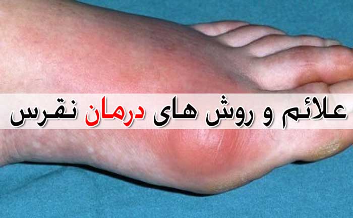 نقرس چیست و چگونه درمان می شود؟ علائم و نشانه ها