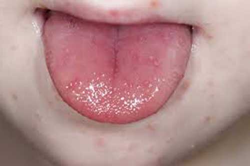 بیماری دست، پا و دهان - علائم + روش های درمان خانگی