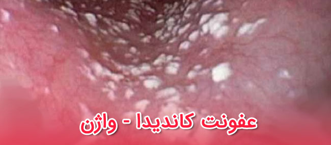 7 درمان طبیعی و گیاهی برای درمان "عفونت قارچی واژن"