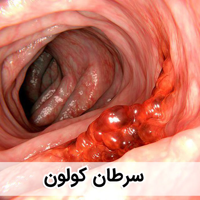عکس سرطان کولون - سرطان روده بزرگ