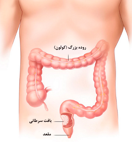 سرطان روده بزرگ - علائم ، دلایل و روش های پیشگیری از سرطان کولون