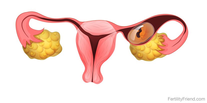 درد شکم در دوران بارداری به دلیل حاملگی خارج از رحم