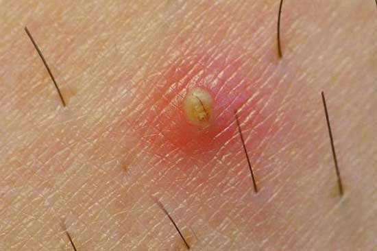 موهای زیر پوستی - روش های جلوگیری از ایجاد