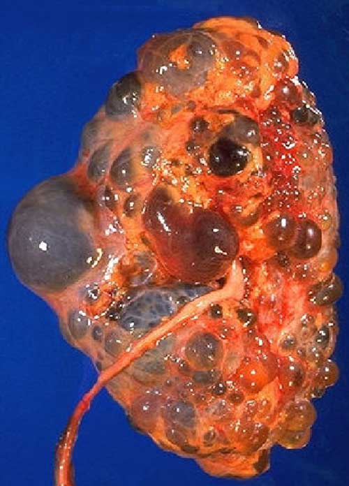 نارسایی کلیه - پیشگیری ، علائم + تشخیص و روش های درمان