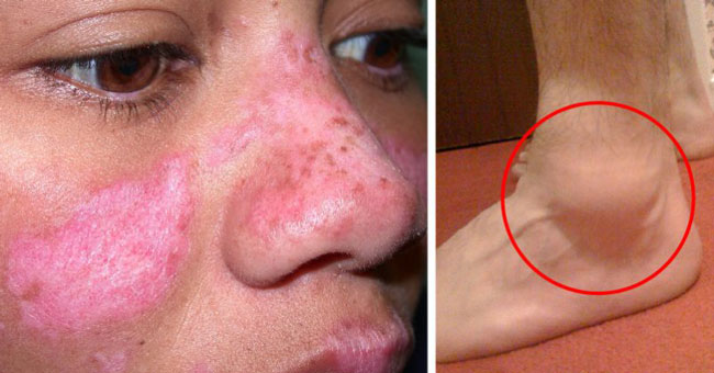 لوپوس - علائم - روش های پیشگیری و درمان lupus