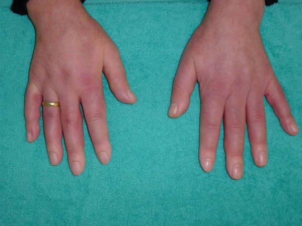 سرد بودن دست ها و پاها - دلایل احساس سرما