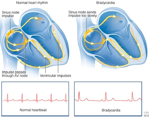 برادی کاردی چیست ؟ دلایل ، علائم و روش های درمان "کندتپشی"