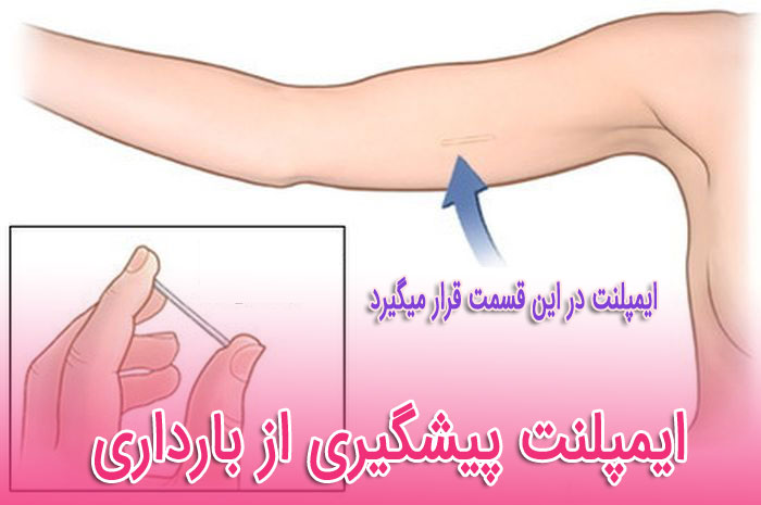  ایمپلنت پیشگیری از بارداری