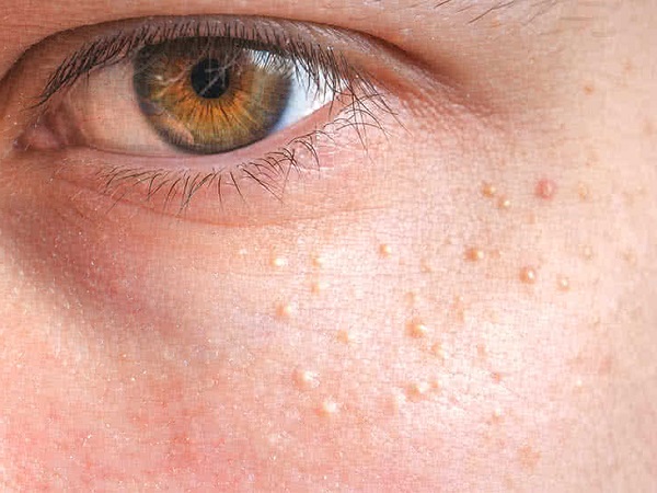 درمان میلیا یا جوش های سفید زیر پوستی