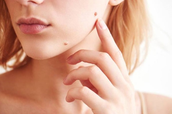 از بین بردن خال با 18 روش گیاهی و طب سنتی - درمان خال