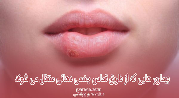 بیماری هایی که از طریق تماس جنسی دهانی منتقل می شوند