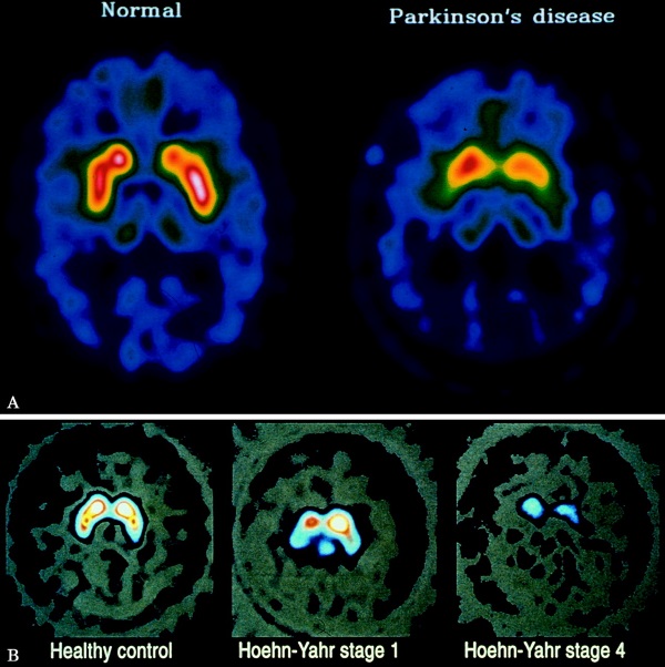فلفل دلمه ای باعث کاهش احتمال بروز بیماری پارکینسون می شود