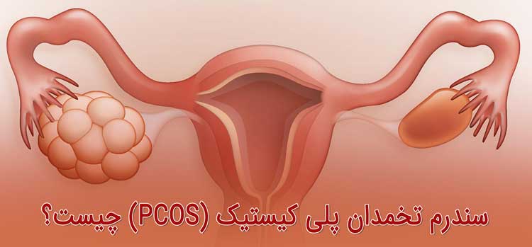 سندرم تخمدان پلی کیستیک (PCOS) - علائم و روش های درمان