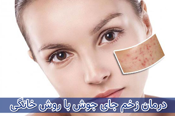 درمان جای جوش با استفاده از عسل