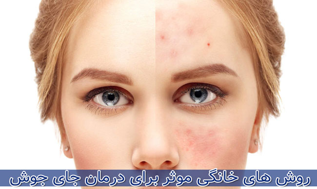 درمان جای جوش با 10 روش گیاهی و خانگی