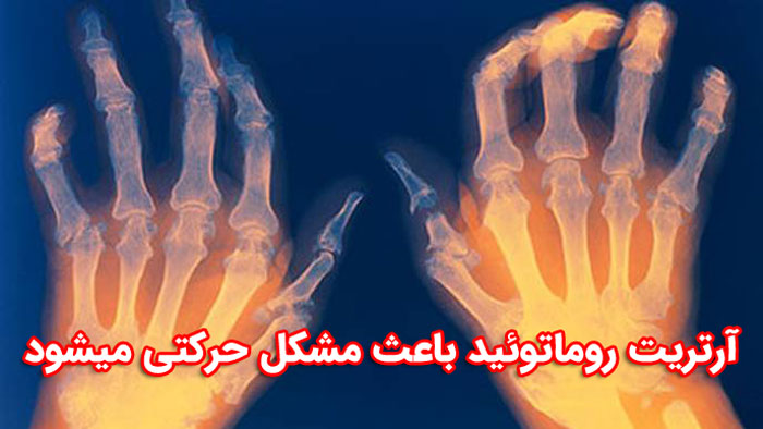 آرتریت روماتوئید بر روی کدام بخش های بدن تاثیر می گذارد ؟