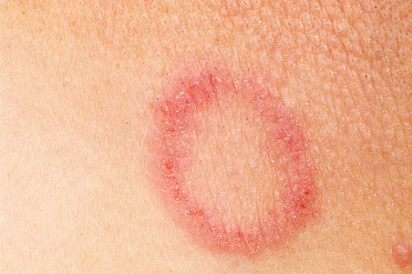 روش های گیاهی برای درمان قارچ های پوستی یا درماتوفیتوز