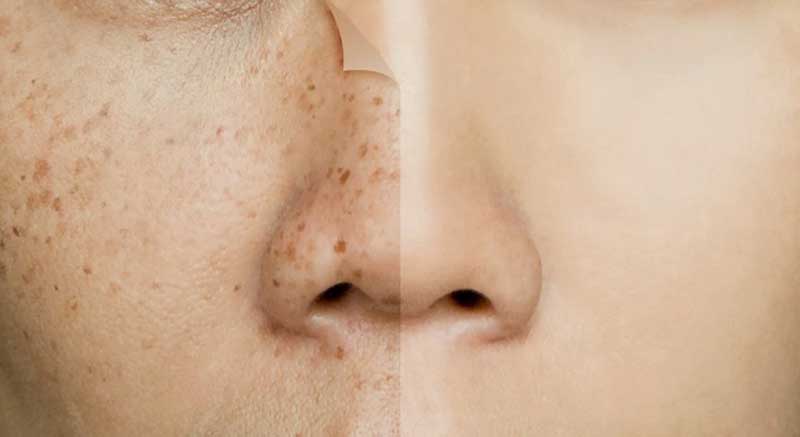 جوانسازی پوست و درمان کک و مک
